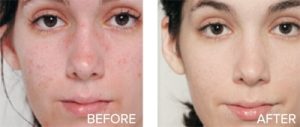 Skin lightening hyperpigmentation vitamin B niacinamide serum x2